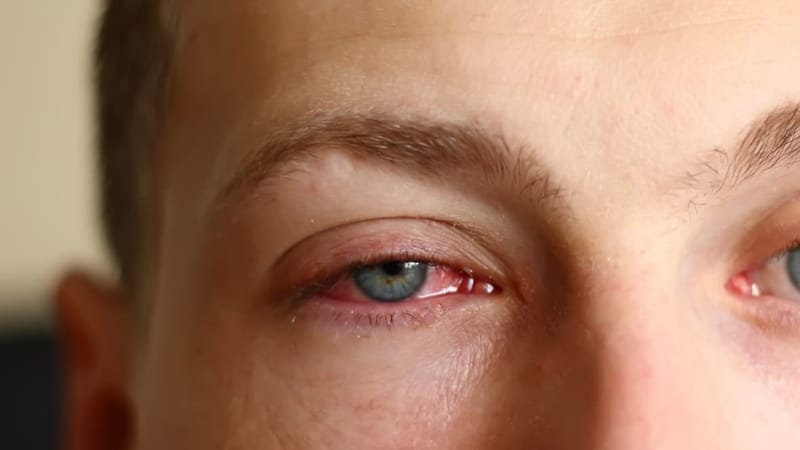 Pink eye infection
