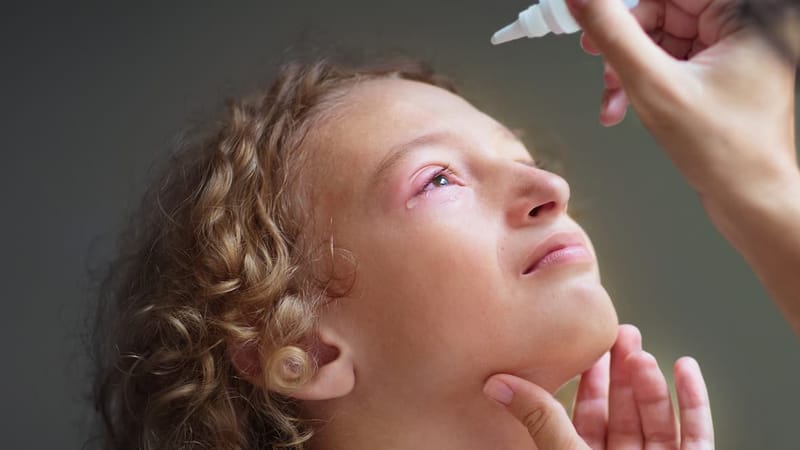 A person using allergy eye drops for pink eye